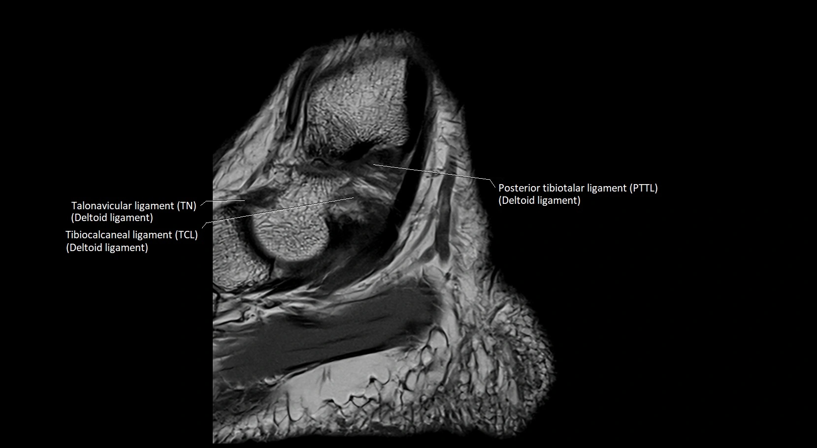 MRI ankle ligaments anatomy sagittal 3T image 5.webp